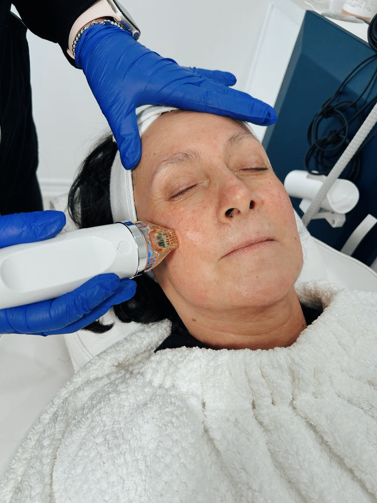 RF Microneedling Free Consultation